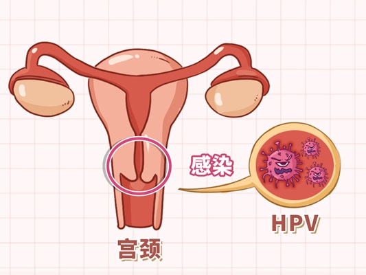 这种癌在妇科恶性肿瘤中发病率排第一，早期多数可治愈！